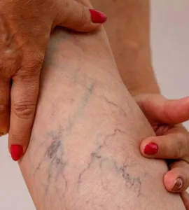 Varices : image, photo d'une personne, une femme tenant ses jambes avec des varices.