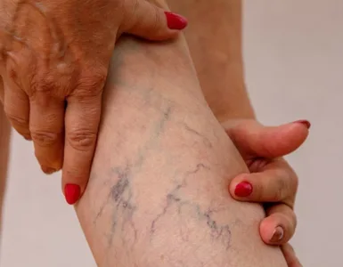 Varices : image, photo d'une personne, une femme tenant ses jambes avec des varices.