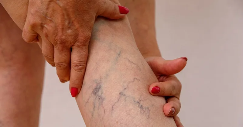 Varices : image, photo d'une personne, une femme tenant ses jambes avec des varices.